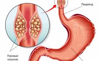 Классификация и причины опухоли пищевода