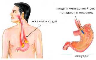 От чего может быть изжога?