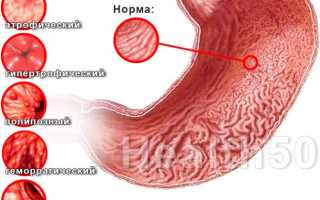 Симптомы и лечение хронического гастродуоденита