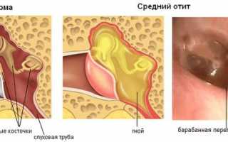 Антибиотики при отите для детей и взрослых — какие лучше принимать