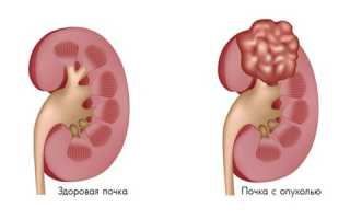 Виды липомы почки, причины возникновения, методы лечения, диагностика и прогноз