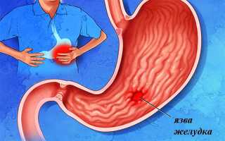 Симптомы кровотечения при язве желудка