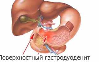 Поверхностный гастродуоденит — симптомы и лечение