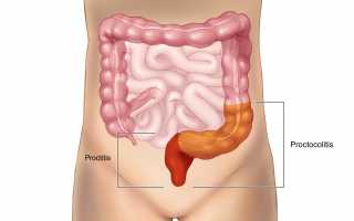 Проктит — болезнь всех возрастов
