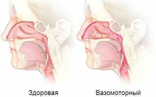 Вазомоторный ринит: диагностика, виды лечения