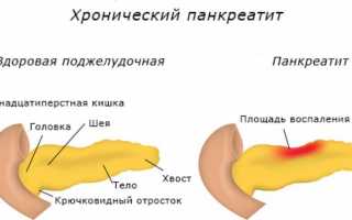 Что такое диастаза: анализ мочи на ферменты и расшифровка их данных