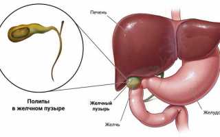 Откуда берутся полипы в желчном пузыре?