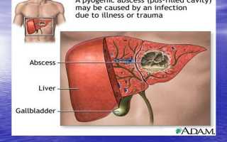 Диагностика и лечение абсцесса печени