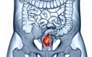 Симптомы и лечение опухоли прямой кишки