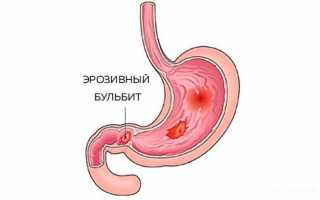 Лечение и диета при воспалении двенадцатиперстной кишки