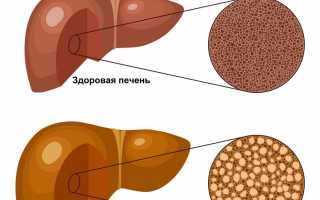 Развитие алкогольного гепатоза печени