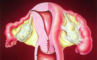 Симптомы и лечение аднексита у женщин