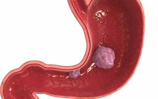Виды, симптомы и методы лечения опухолей желудка