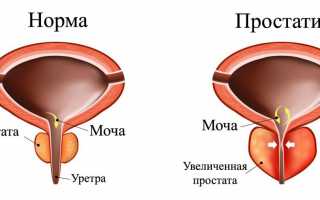 Прибор “Союз-Аполлон” от простатита: инструкция по применению, отзывы