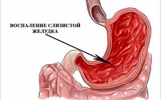Воспаление желудка при остром гастрите