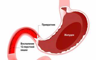 Симптомы и лечение хронического дуоденита