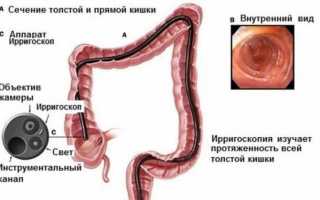 Возможно ли проверить кишечник без колоноскопии и как это сделать?