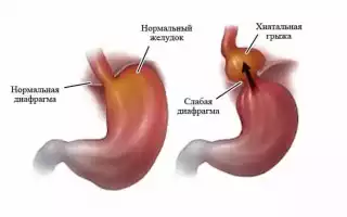 Основные способы исцеления грыжи желудка