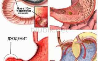 Симптомы и лечение поверхностного дуоденита