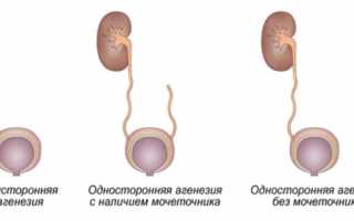 Причины развития агенезии почки, классификация, симптомы, лечение и прогноз