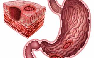 Почему возникает и как лечится язва желудка?