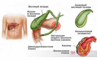 Методика лечения хронического холецистита