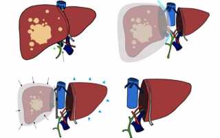 Как проводится резекция печени?