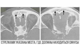 Придаточные и околоносовые пазухи носа: это одно и тоже