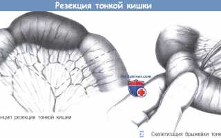 Для чего и как проводится резекция кишечника?